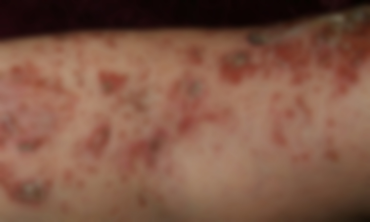 “옷깃만 스쳐도 아픈데… ” 대상포진 환자 6년간 356만명, 예방접종 지원 공백 심각