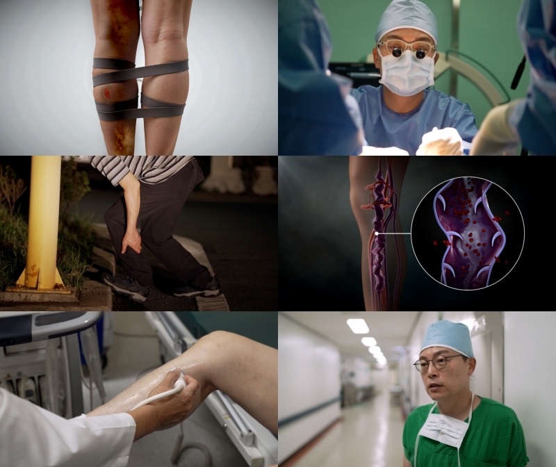 내 다리가 아픈 진짜 이유는…10일 EBS1 ‘명의’서 다리 혈관 질환 다뤄