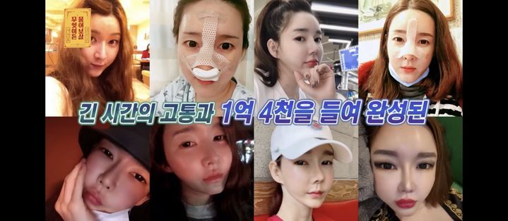 성형 중독 트렌스젠더 “수술비만 1억 4000만원”