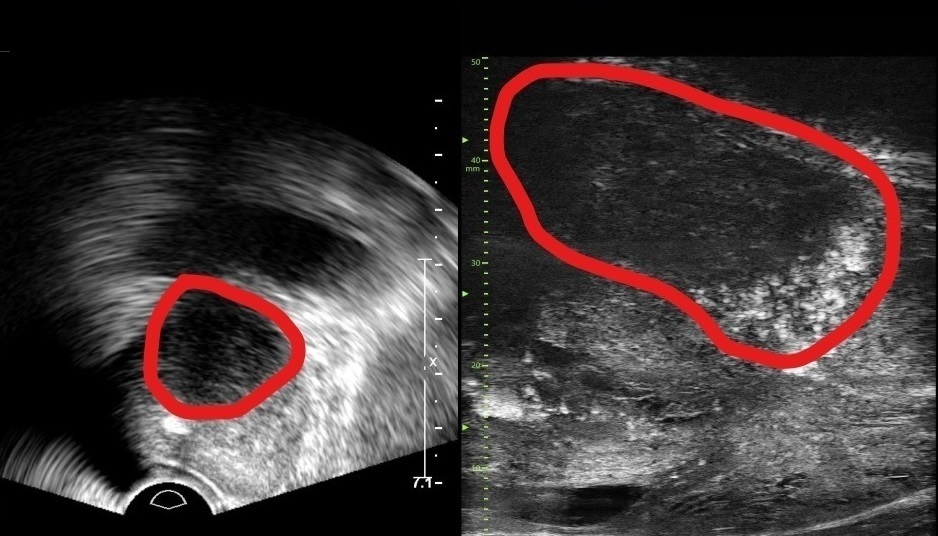 ‘마이크로 초음파’로 미세 전립선암도 찾는다