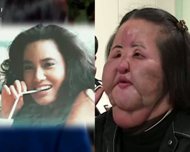 '선풍기 아줌마', 성형 택했던 이유? 불법 성형 전 모습 보니…