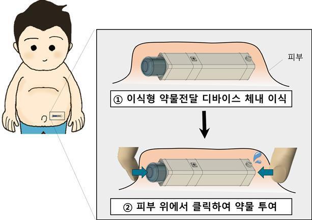 당뇨 환자 등에 희소식...버튼으로 쉽게 체내서 약물 주입 - 뉴스 썸네일 이미지