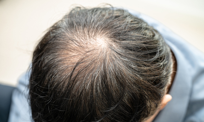 The Ultimate Beauty Blunder: What’s More Dreaded than Balding Among Singles